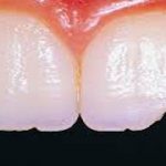 A Summary Of Cracked Teeth